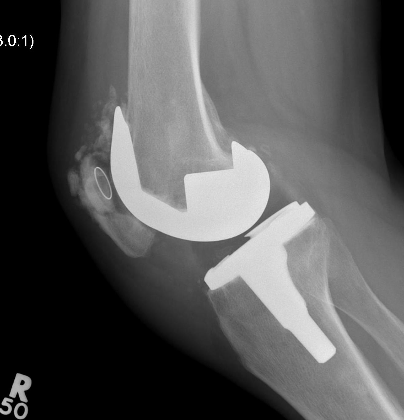 Patella AVN Lateral